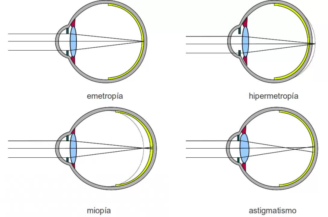 ¿Qué son la Miopía, Hipermetropía, Astigmatismo y Presbicia?