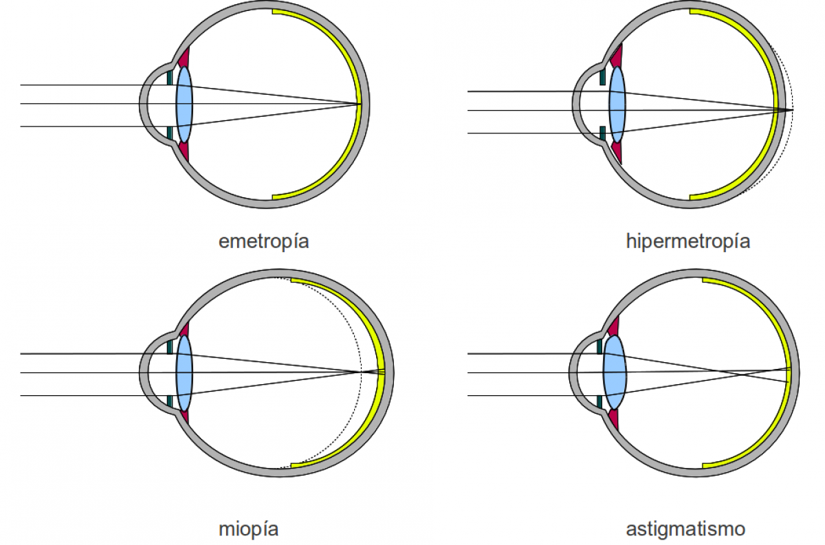¿Qué son la Miopía, Hipermetropía, Astigmatismo y Presbicia?